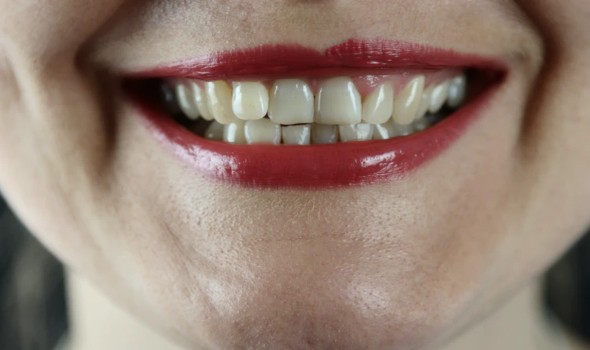 علامات تسوس الأسنان الشديد وطرق الوقاية