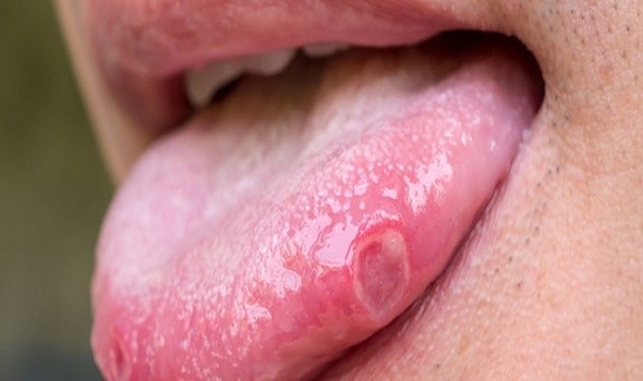 حالات طبية مقلقة قد تكون رائحة الفم الكريهة علامة لها بينها السرطان